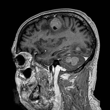 Brain metastases from lung cancer (Radiopaedia 83839-99028 Sagittal T1 C+ 47).jpg