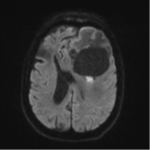 Brain metastasis (lung cancer) (Radiopaedia 48289-53179 Axial DWI 46).png