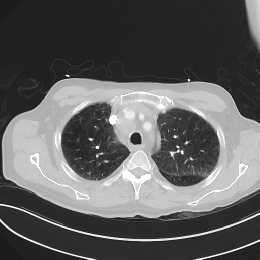 File:Brain metastasis (lung cancer) (Radiopaedia 48289-53180 Axial lung window 16).png
