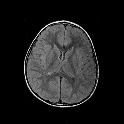 File:Brainstem ganglioglioma (Radiopaedia 10763-11224 Axial FLAIR 9).jpg