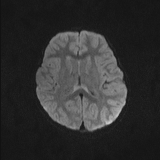 Brainstem glioma (Radiopaedia 67531-76922 Axial DWI 38).jpg
