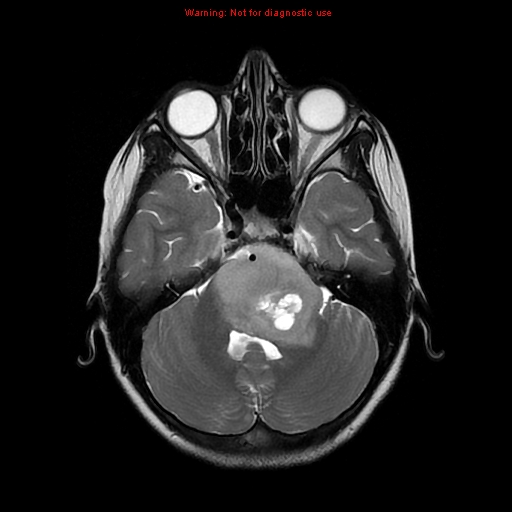 File:Brainstem glioma (Radiopaedia 9444-10124 Axial T2 6).jpg