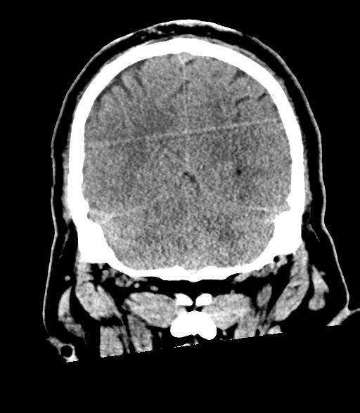 Brainstem hemorrhage (Radiopaedia 81294-94976 Coronal non-contrast 52).jpg