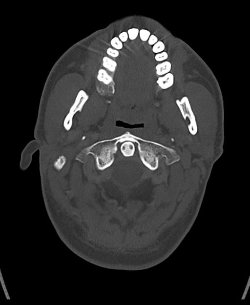 Branchial cleft cyst (Radiopaedia 31167-31875 Axial bone window 18).jpg