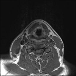File:Branchial cleft cyst (Radiopaedia 31167-31876 Axial T1 4).jpg
