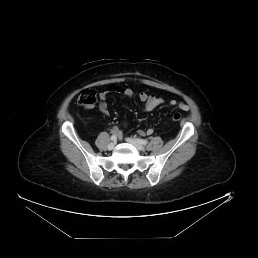 File:Breast cancer pseudocirrhosis with lobar invovlement (Radiopaedia 81080-94670 A 112).jpg
