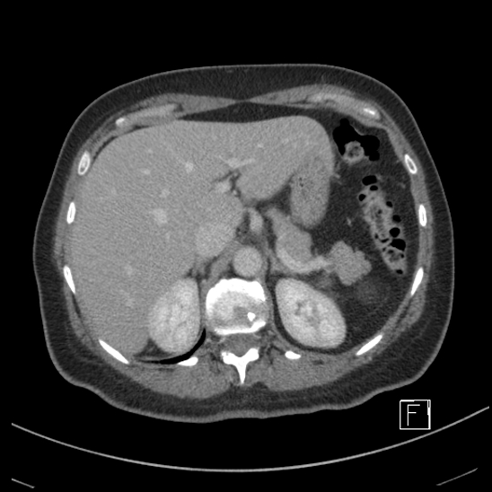Breast metastases from renal cell cancer (Radiopaedia 79220-92225 C 22).jpg