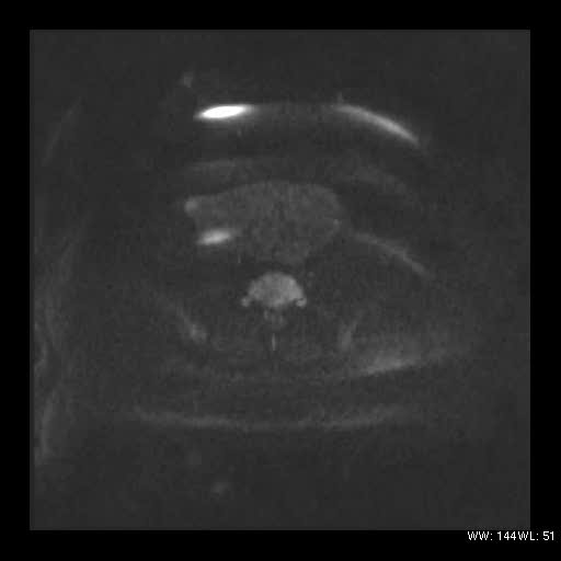 File:Broad ligament fibroid (Radiopaedia 49135-54241 Axial DWI 10).jpg