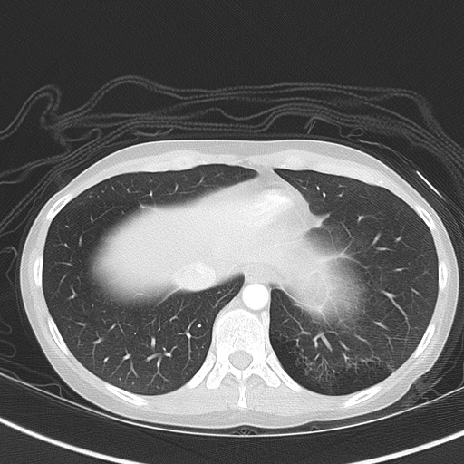 Bronchial atresia (Radiopaedia 73677-84470 Axial lung window 48).jpg