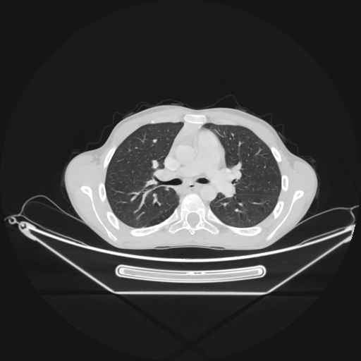 Bronchial carcinoid tumor (Radiopaedia 57187-64090 Axial lung window 29).jpg