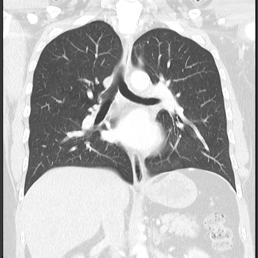 Bronchial carcinoid tumor (Radiopaedia 67377-76764 Coronal lung window 39).jpg