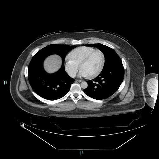 Bronchial carcinoid tumor (Radiopaedia 78272-90870 C 78).jpg