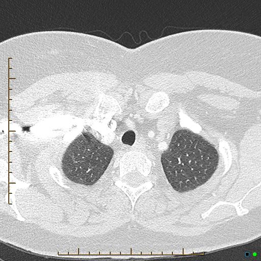 Bronchial diverticula (Radiopaedia 79512-92676 Axial lung window 13).jpg