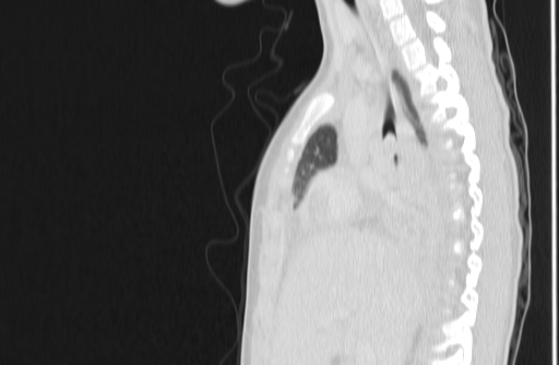 Bronchial mucoepidermoid carcinoma (Radiopaedia 57023-63895 Sagittal lung window 61).jpg