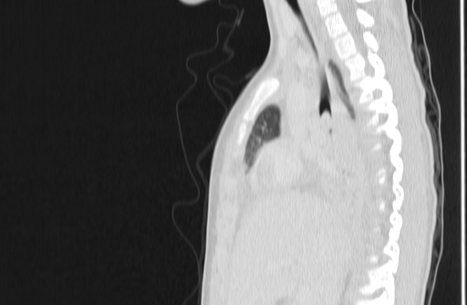 Bronchial mucoepidermoid carcinoma (Radiopaedia 57023-63895 Sagittal lung window 62).jpg