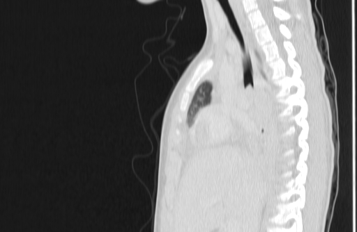 Bronchial mucoepidermoid carcinoma (Radiopaedia 57023-63895 Sagittal lung window 64).jpg