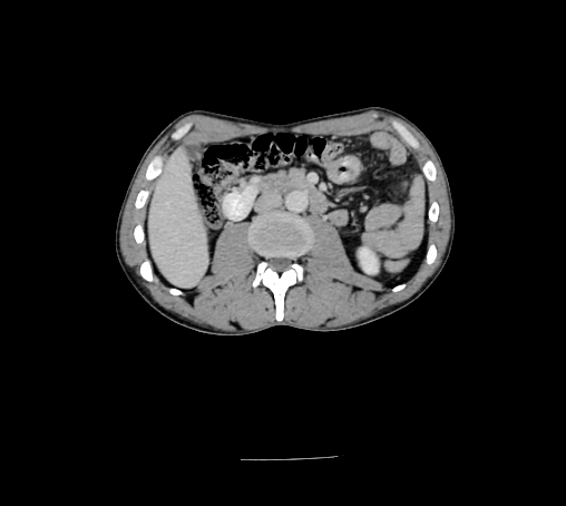 Bronchiectasis in Crohn disease (Radiopaedia 60311-67977 B 79).jpg