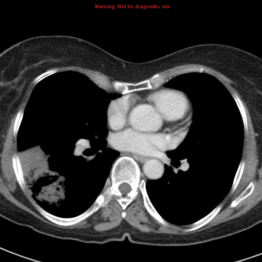 File:Bronchoalveolar carcinoma (BAC) (Radiopaedia 13436-13392 B 30).jpg