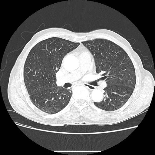 Bronchocele (Radiopaedia 17097-16795 Axial lung window 58).jpg