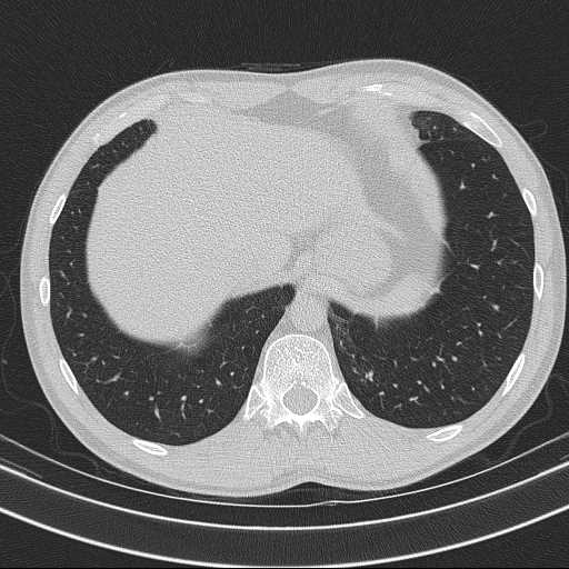 Bronchocele (Radiopaedia 60676-68429 Axial lung window 63).jpg