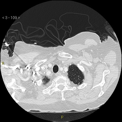 Bronchogenic carcinoma as an incidental finding (Radiopaedia 16453-16130 Axial lung window 109).jpg