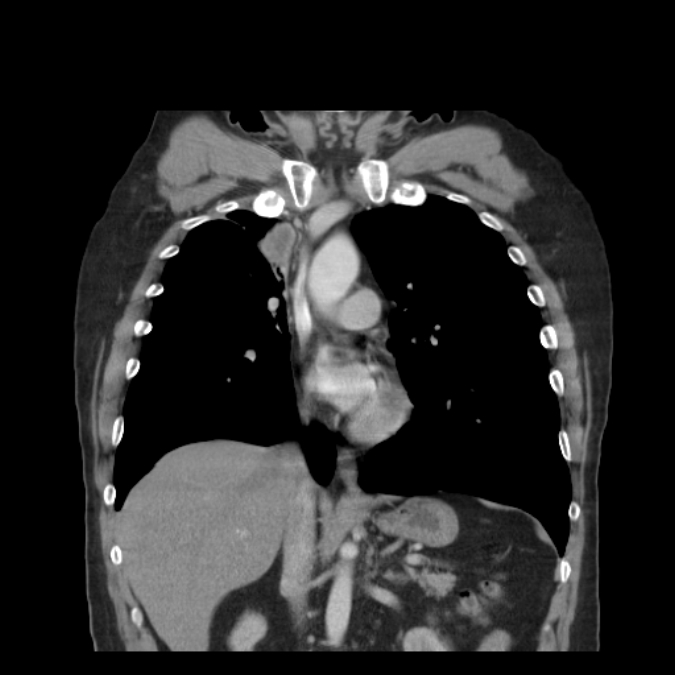Bronchogenic carcinoma with upper lobe collapse (Radiopaedia 29297-29726 D 28).jpg
