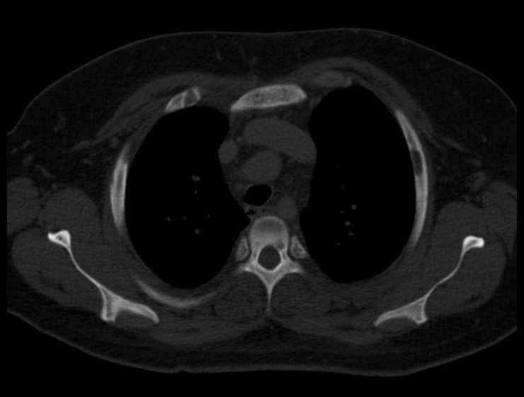 Brown tumors compressing the spinal cord (Radiopaedia 68442-77988 Axial bone window 18).jpg