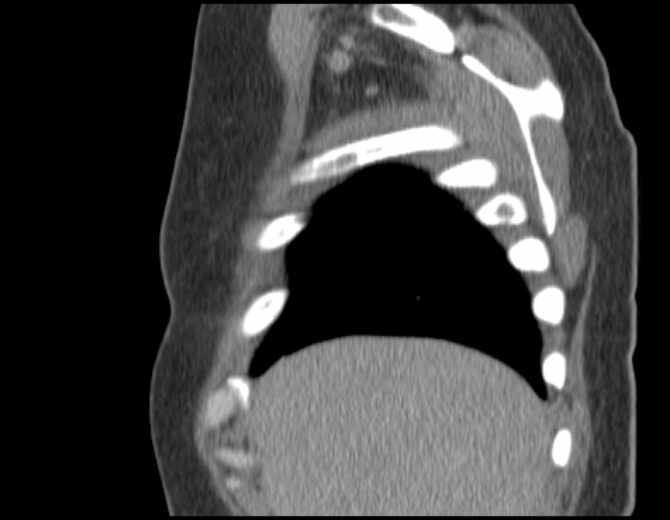 File:Brown tumors compressing the spinal cord (Radiopaedia 68442-77988 B 12).jpg