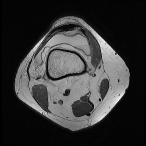 File:Bucket handle meniscus tear (Radiopaedia 56916-63751 Axial PD 1).jpg