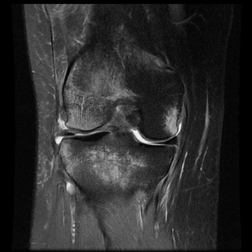 File:Bucket handle meniscus tear (Radiopaedia 56916-63751 Coronal PD fat sat 12).jpg