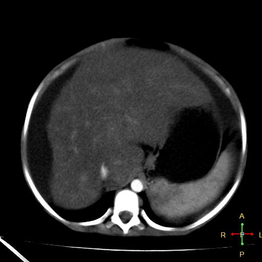 File:Budd-Chiari syndrome (Radiopaedia 23072-23103 C+ arterial phase 5).jpg