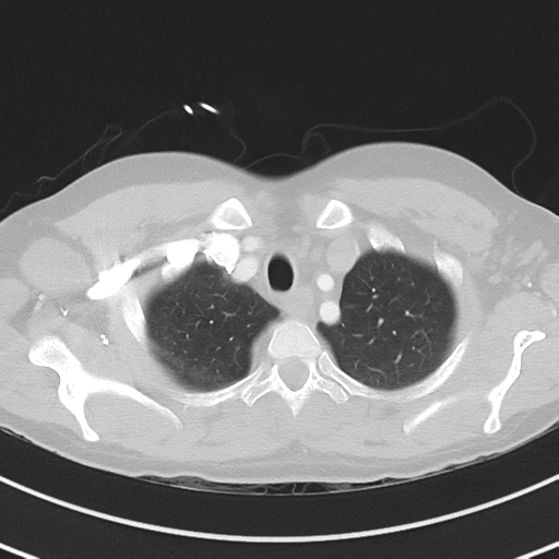 Burkitt lymphoma (Radiopaedia 34686-36121 Axial lung window 9).png