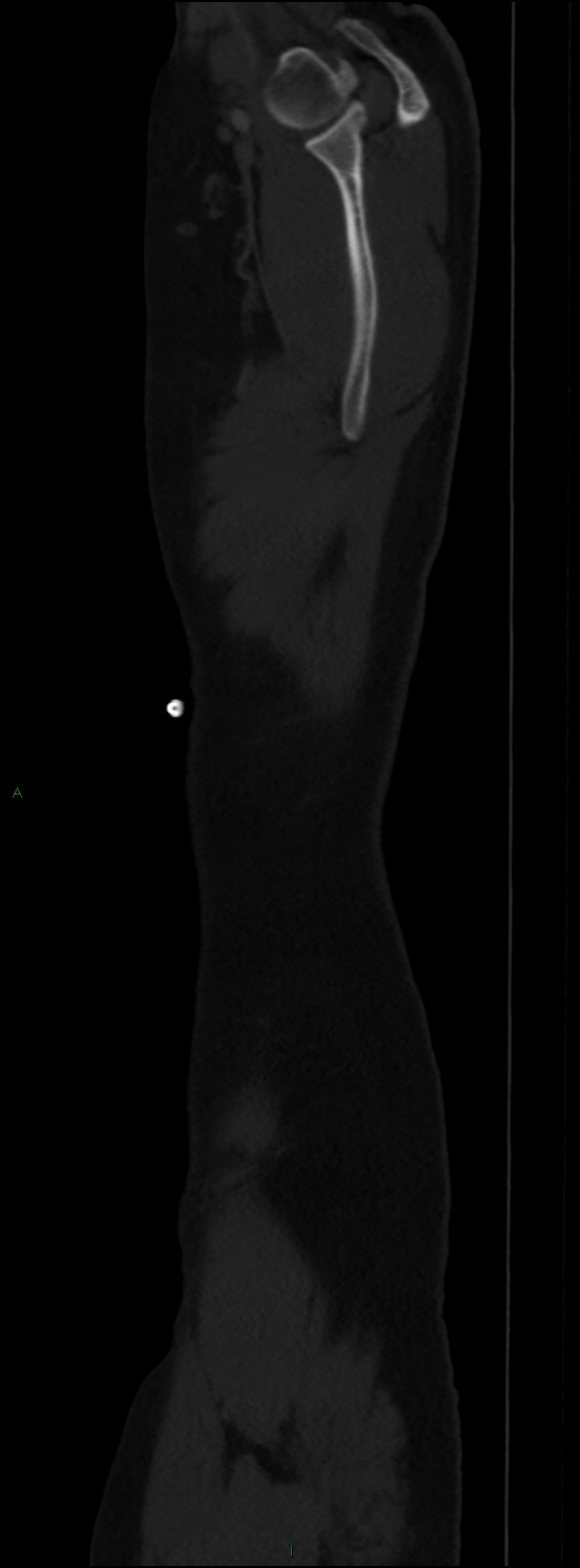Burst fracture (Radiopaedia 83168-97542 Sagittal bone window 115).jpg