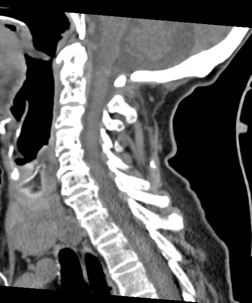 C2 fracture with vertebral artery dissection (Radiopaedia 37378-39199 D 41).png