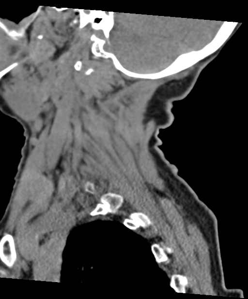 C2 fracture with vertebral artery dissection (Radiopaedia 37378-39199 D 61).png