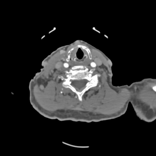File:C2 fracture with vertebral artery dissection (Radiopaedia 37378-39200 A 107).png