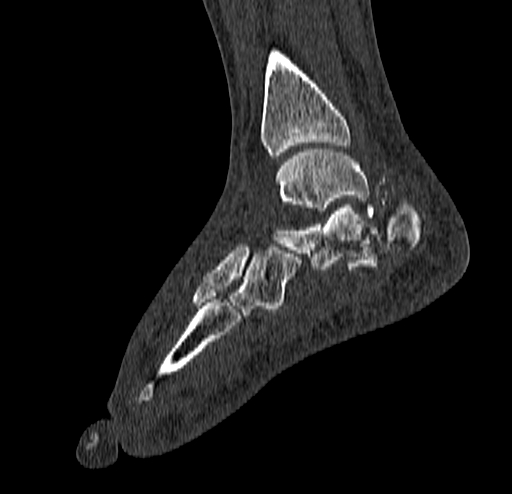Calcaneal fracture - Sanders type 4 (Radiopaedia 90179-107370 Sagittal bone window 53).jpg