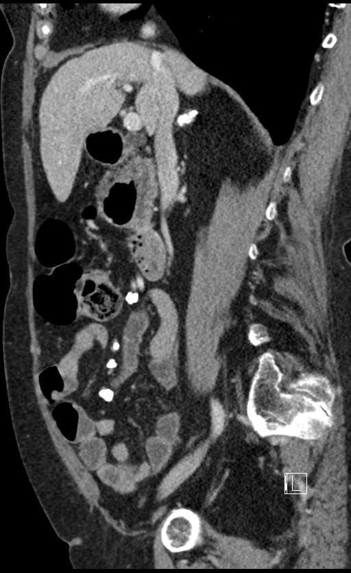 Calcified adrenal glands and Spigelian hernia (Radiopaedia 49741-54988 C 100).jpg