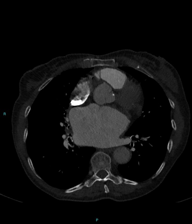 Calcified cerebral emboli from left ventricular thrombus (Radiopaedia 84420-99760 Axial bone window 49).jpg