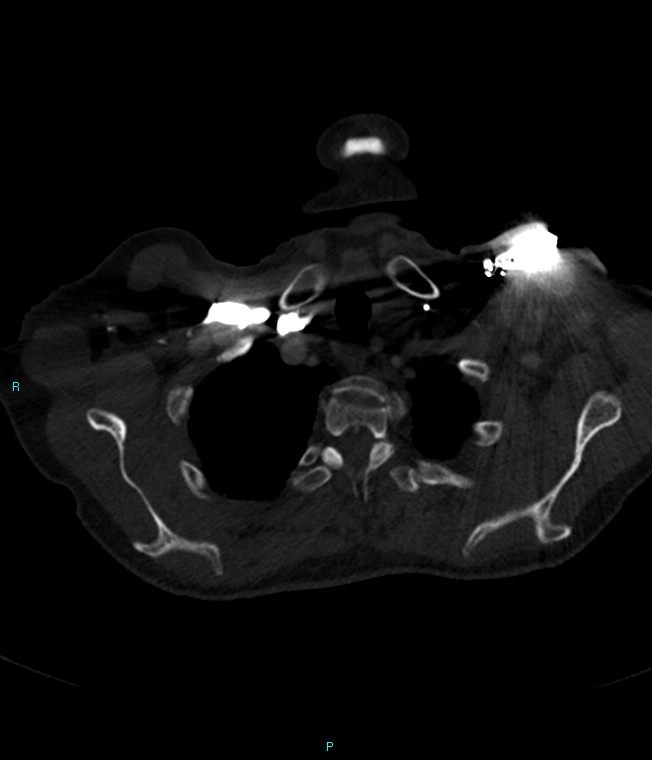 Calcified cerebral emboli from left ventricular thrombus (Radiopaedia 84420-99760 Axial bone window 8).jpg