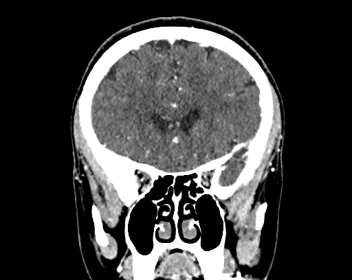 File:Calcified cerebral hydatid cyst (Radiopaedia 65603-74717 C 20).jpg