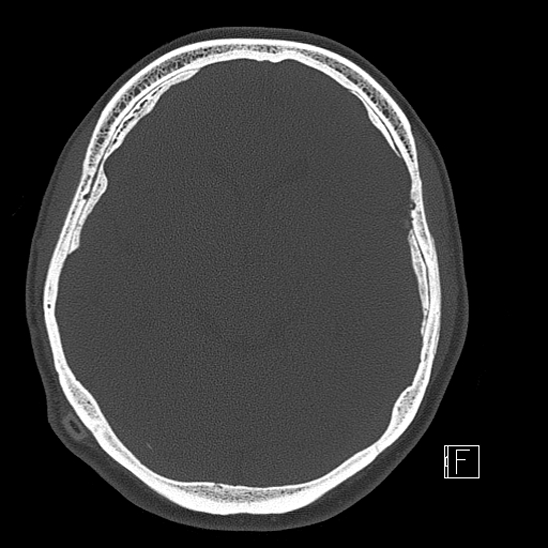 Calcified chronic subdural hematoma (Radiopaedia 77374-89492 Axial bone window 57).jpg