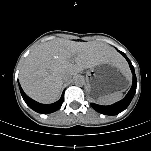 File:Calcified hepatic hydatid cyst (Radiopaedia 83870-99072 Axial non-contrast 34).jpg