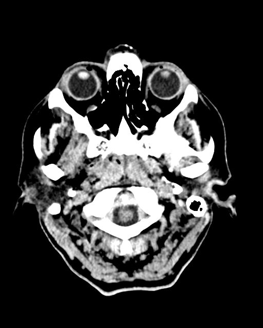 Calcified meningioma (Radiopaedia 74361-85243 Axial non-contrast 48).jpg