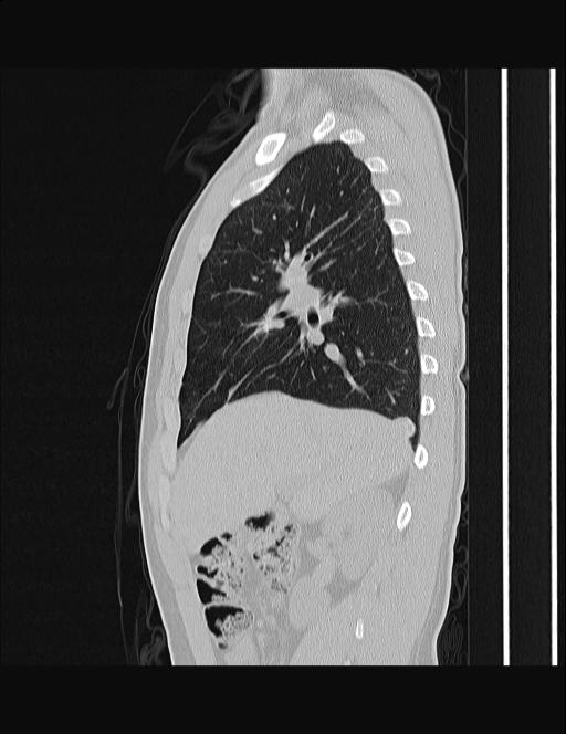 Calcifying pulmonary metastases (Radiopaedia 33359-34396 Sagittal lung window 47).jpg