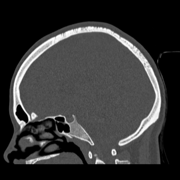 Calvarial osteoma (Radiopaedia 36520-38079 Sagittal bone window 58).jpg