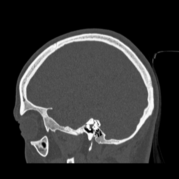 Calvarial osteoma (Radiopaedia 36520-38079 Sagittal bone window 79).jpg
