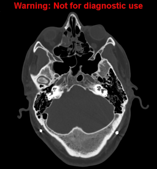Calvarial thickening from chronic shunting (Radiopaedia 60079-67637 Axial bone window 38).jpg