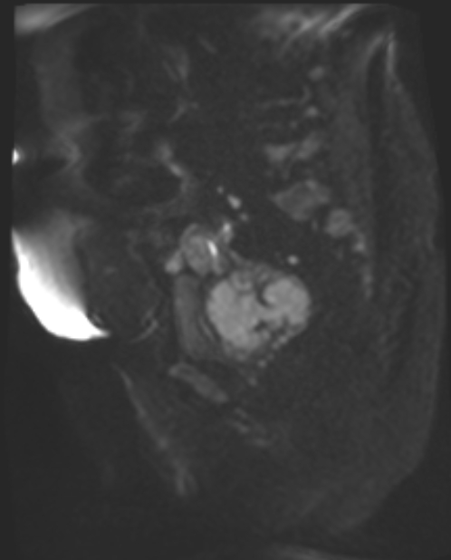 Cancer cervix - stage IIb (Radiopaedia 75411-86615 Sagittal DWI 56).jpg