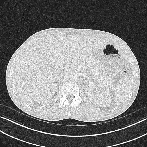 Cannonball metastases - testicular choriocarcinoma (Radiopaedia 84510-99891 Axial lung window 98).jpg